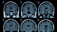 Santé: une étude révèle une accumulation de microplastiques dans le cerveau